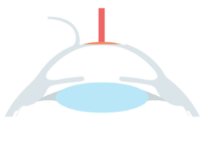 Beispiel Femto LASIK Augenlaser